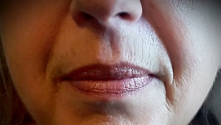 Dermal Filler Treatment for nasolabial folds, upper vermillion border of lip & marionette lines