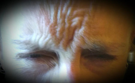 Muscle Relaxant glabellar lines