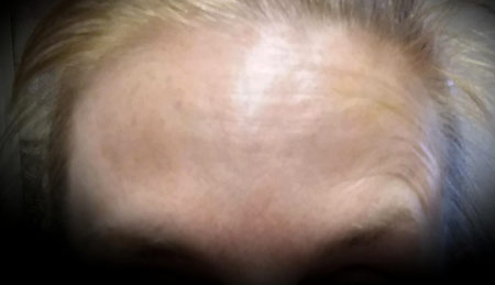 Muscle Relaxant forehead lines